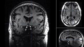 Approaches to neuromodulation for schizophrenia