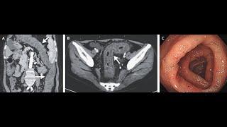 Angioödem des Intestinums