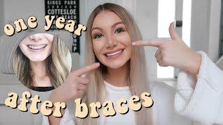 1 YEAR AFTER BRACES  Have my teeth moved?