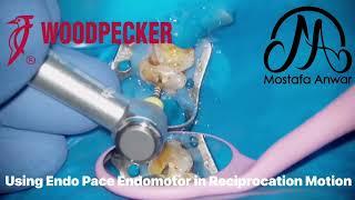 How to Manage Inflamed Pulp? Using WOODPECKER “Endo Pace” Endomotor  Reciprocation  Intrapulpal