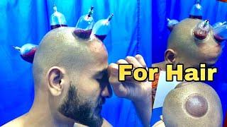 Hijama  Cupping for Hair growth   Why & How to   Hijama cupping benefits  Amaan Ullah