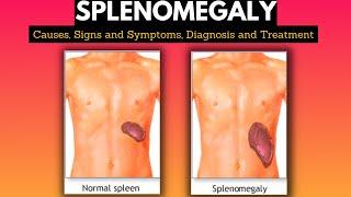 Splenomegaly Causes Signs and Symptoms Diagnosis and Treatment