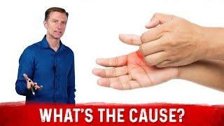 What Causes Sweaty  Dry Hands & How To Get Rid Of It? – Dr. Berg