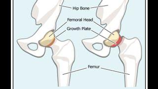 Slipped Capital Femoral Epiphysis SCFE