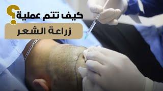 من داخل العمليات خطوات عملية زراعة الشعر مع د. شريف حجازي