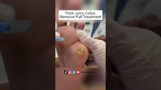 Ultimate Callus Removal Full Treatment For Smooth Feet  FootClinicLondon.co.uk