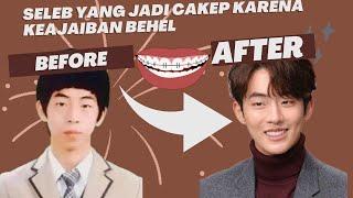 BEFORE AFTER PENAMPILAN SELEBRITI TERKENAL SETELAH PAKAI BEHEL  ADA NAM JOO HYUK