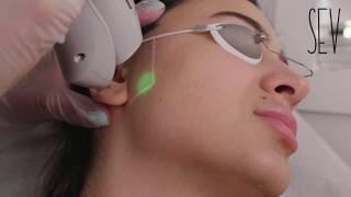 FACE HAIR REMOVAL  SEV LASER