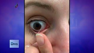 Why Eye Mucus Removal Videos are Popular on TikTok
