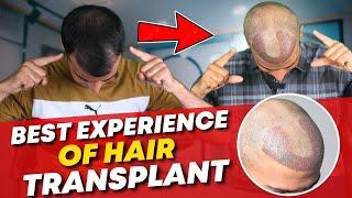 Hair Transplant in India  Best Results & Cost of Hair Transplant in India