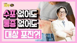 ‘대상 포진’에 대한 오해와 진실 후유증 없애는 치료 포인트는? - 박치영의 피부 톡톡 #76 대상포진