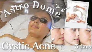 Oxygen Therapy Facial for Breakouts & Cystic Acne  Skincare Treatments ft. OxygenCeuticals