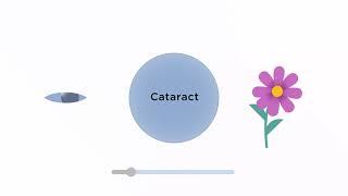 Cataract Surgery Fixed vs  Adjustable Lenses  RX Sight  Light Adjustable Lens