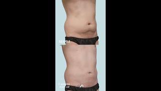 Male Body Enhancement  360 Liposuction + Gynecomastia  Dr. David Stoker