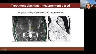 Treatment of essential tremor using high intensity focused ultrasound with Dr. Pejman Ghanouni