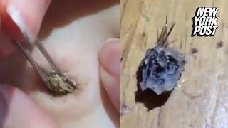 Girl removes gigantic hairy blackhead from her belly button