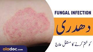 How To Remove Fungal Infection Urdu Hindi- DaadDadri Ka Ilaj - Ringworm Removal - Chambal Ka Ilaj