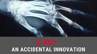 X RAY AN ACCIDENTAL INNOVATION  SCIENCE AND INNOVATIONS  MEDIA IDEA 