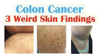 3 Weird Signs of Colon Cancer Found on the Skin