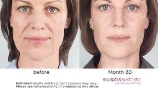 Sculptra  Facial Injectable for Anti Aging @ Enhanze Clinic