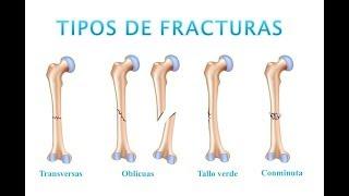 Tipos de Fracturas