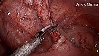 Pediatric Laparoscopic Appendectomy by Two Ports