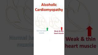 Heart Disease Due to Alcohol