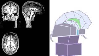 MRI  3D Brain Anatomy Hypothalamus Pituitary Gland Fornix Corpus Callosum & 3rd Ventricle