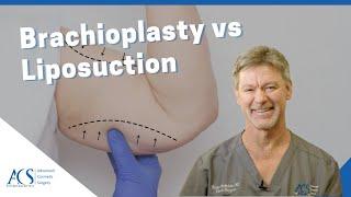 Brachioplasty Arm Lift Surgery Vs. Liposuction Explained By Plastic Surgeon Dr. Tom McFadden