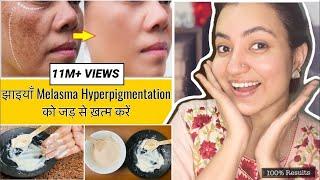 कितने भी मुश्किल झाइयाँ Hyperpigmentation Melasma काले धब्बे Spots हो इस Remedy से होगा 100% इलाज 