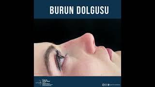 AMELİYATSIZ BURUN ESTETİĞİ BURUN DOLGUSU