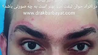 جراحی اصلاح اسکار و جای زخم