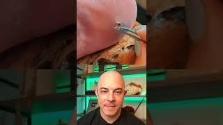 Doctor reacts to fat splinter removal #dermreacts #doctorreacts #splinter #splinterremoval