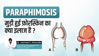 What is Paraphimosis in Hindi - its Symptoms & Treatment  Foreskin peechay atak jaye to kya karein?