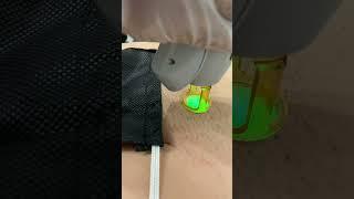 Laser Hair Removal at SEV  DISCLAIMER This client was unshaven due to video purposes 