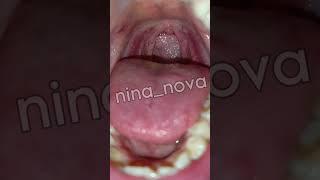 Tongue mouth uvula after tooth removal surgery