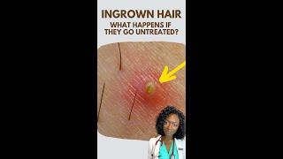 Ingrown Hair What happens if they go untreated? #shorts