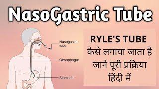 Ryle’s Tube  Nasogastric Tube – Nursing Assistant Course