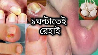 Nokh kuni treatment banglaনখের কুনী দূর করার উপায়home remedy
