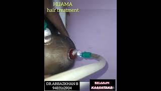 HIJAMA FOR HAIR REGROWTHHAIRFALLINGDANDRUFF  THINNING OF HAIR #hijama #cuppingtherapy #dr