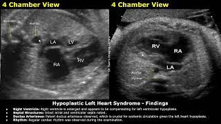 Fetal Chest Ultrasound & Echocardiography Reporting  Heart & Lungs Diseases USG Scan Reports