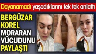 Bergüzar Korel Moraran Vücudunu Paylaştı Dayanamadı Yaşadıklarını Anlattı