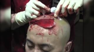 Body Modifications Extreme - Implant in the Head