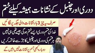 How To Remove Ringworm From Skin Permanently at Home in Urdu  Tadri Ka Desi ilaj Dr Sharafat Ali