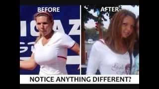 simona halepСимона Халеп breasts before and after reducers plastic surgery