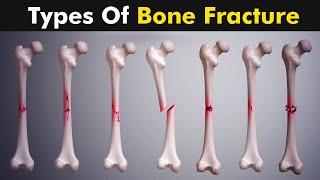 Common types of Bone fracture  3D animation 