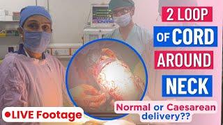 Baby के गर्दन पे अगर नाल फस जाये तो Doctor Delivery कैसे करते है? 2 Loop of Cord Around Babys Neck