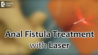 Anal Fistula Treatment with Laser. Painless and best recovery for fistula - Dr. Rajasekhar M R