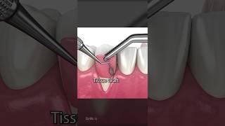 Soft Tissue Graft Surgery for Receding Gums