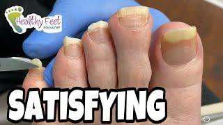 TWO INCH LONG TOENAILS TRIMMED SO SATISFYING AND SOOTHING TO WATCH